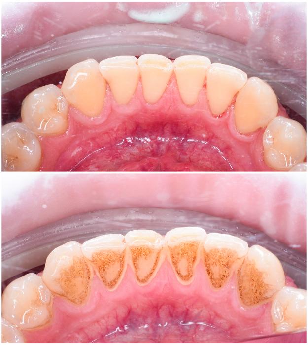 before and after teeth cleaning in knoxville