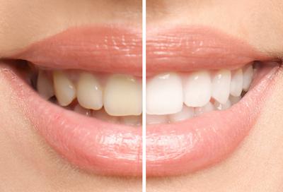 before and after teeth whitening knoxville